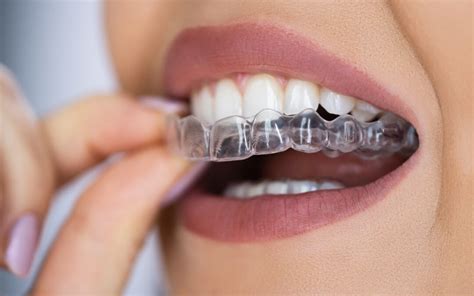 candidbestpremium.com|clear teeth aligners.